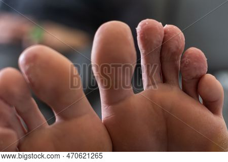 A White Man Holding His Toes, Showing What Looks Like A Rash With Red Blotchy Skin. A Common Side Ef