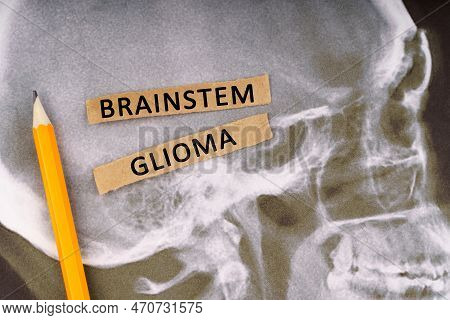 Medical Concept. On X-rays Of A Human Skull, A Pencil And Strips Of Paper With The Inscription - Bra