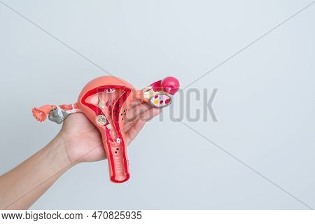 Woman Holding Uterus And Ovaries Model. Ovarian And Cervical Cancer, Cervix Disorder, Endometriosis,