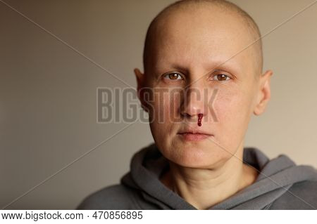 Young Bald Cancer Sick Woman Is Bleeding From Her Nose, Effects Of Chemotherapy. Female Lost Her Eye