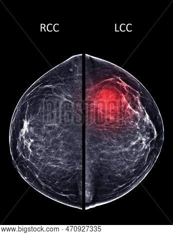 X-ray Digital Mammogram Or Mammography Of Both Side Breast Standard Views Are Bilateral Craniocaudal