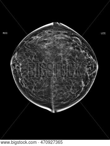 X-ray Digital Mammogram Or Mammography Of Both Side Breast Standard Views Are Bilateral Craniocaudal