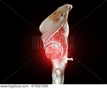 Ct Scan Of Pelvic Bone And Hip Joint 3D Rendering For Diagnosis Fracture Of Pelvic Bone And Hip Join