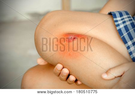 Child injured. Close up wound on child leg. Mother dressing child's leg after Children have been an accident
