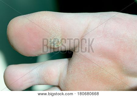 Plantar Wart On Big Toe. Visible Black Dots Warts.
