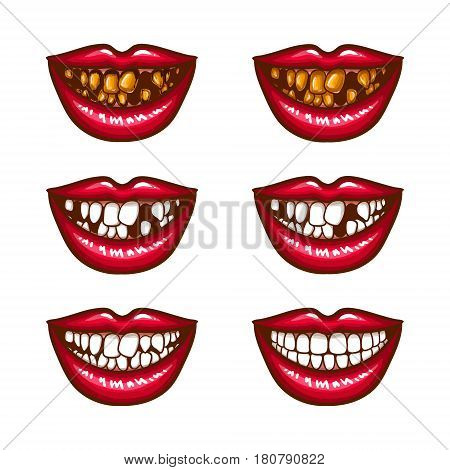A collection of pop art icons of red female lips - smiling, with missing teeth, with spoiled teeth. Badges, stickers, design elements, prints for T-shirts