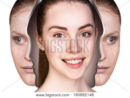 Young woman rebirth from bad acne skin to perfect. Before and after treatment.