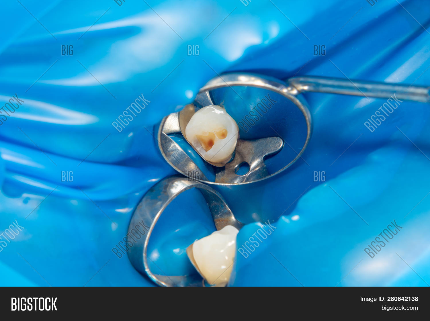 Dental Caries. Filling Image & Photo (Free Trial) Bigstock