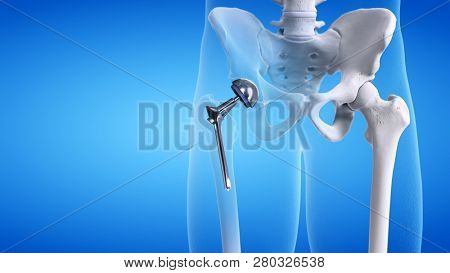 3d rendered medically accurate illustration of a hip replacement