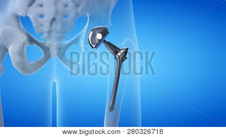 3d rendered medically accurate illustration of a hip replacement