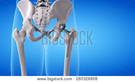 3d rendered medically accurate illustration of a hip replacement
