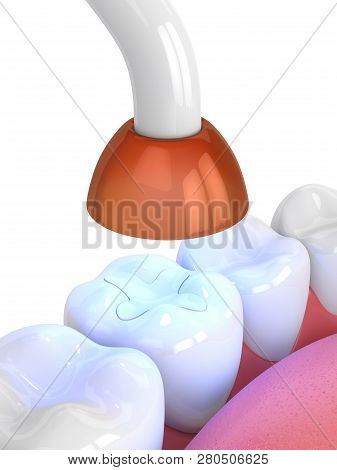 3d Render Of Jaw With Dental Polymerization Lamp And Light Cured Inlay Filling Over White Background