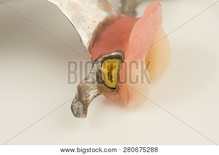 Bugel Remove Dentures With Attachments On White Background