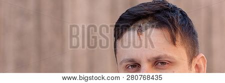 Suture Wound At Skull With Wires, Postoperative Stitching Craniectomy With Many Staples, Medical Sew