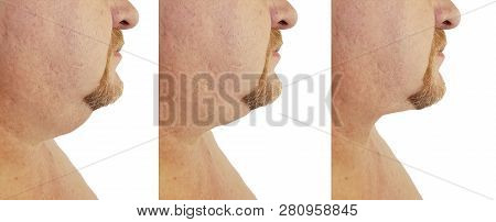 Submental Fat Man Before And After, Procedures