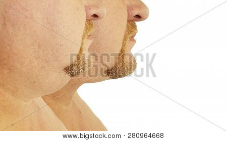 Submental Fat Man Before And After, Procedures