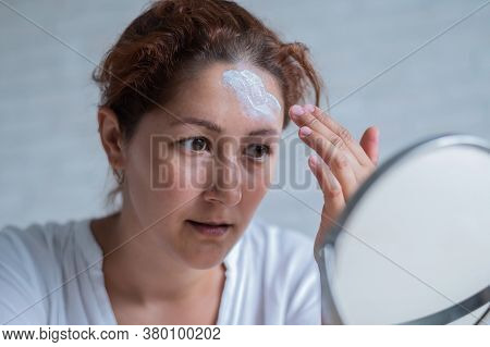 Portrait Of A Caucasian Woman With Vitiligo Uses Sunscreen. A Girl With A White Pigment Spot On Her 