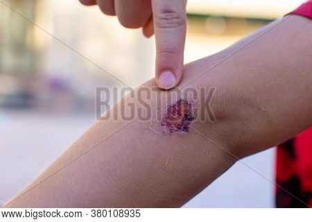 Pointing At Scab From Bleeding Elbow Of A Child (boy) After A Fall Making A Minor Emergency And Need