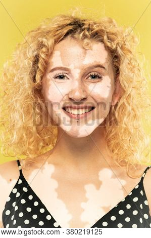 Portrait Of Caucasian Woman With Vitiligo Skin. Special Skin With Depigmentation Because Of Melanin 