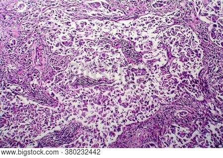 Breast Ductal Carcinoma, Light Micrograph, Photo Under Microscope