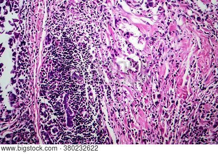 Breast Ductal Carcinoma, Light Micrograph, Photo Under Microscope