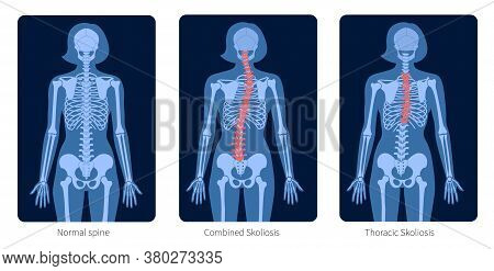 Normal Spine And Types Of Spine Defects. Scoliosis In Woman Body. Xray Flat Vector Illustration. Bac
