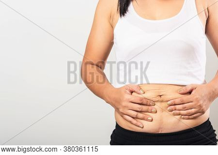 Close Up Of Asian Mother Woman Showing Stretch Mark Loose Lower Abdomen Skin She Fat After Pregnancy