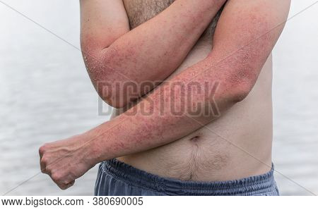 Dyshidrotic Autoimmune Eczema Of Patient. Concept Of Health Care