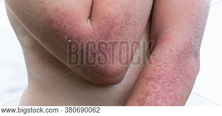 Dyshidrotic Autoimmune Eczema Of Patient. Concept Of Health Care
