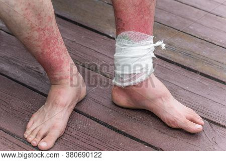 Dyshidrotic Autoimmune Eczema Of Patient. Concept Of Health Care