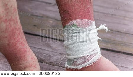 Dyshidrotic Autoimmune Eczema Of Patient. Concept Of Health Care