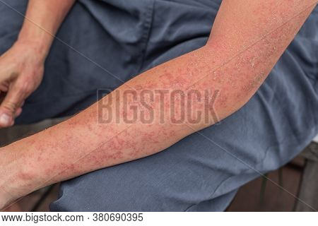 Dyshidrotic Autoimmune Eczema Of Patient. Concept Of Health Care