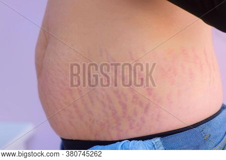 Womans Abdomen After Carboxytherapy Injections In Clinic, Closeup Side View. Treatment, Cure And Rem