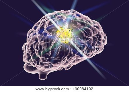 Destruction of brain tumor by laser, 3D illustration. Conceptual image for brain cancer treatment
