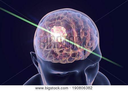 Destruction of brain tumor by laser, 3D illustration. Conceptual image for brain cancer treatment