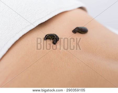 Patient During Leech Therapy, Alternative Hirudotherapy, Blood Purification
