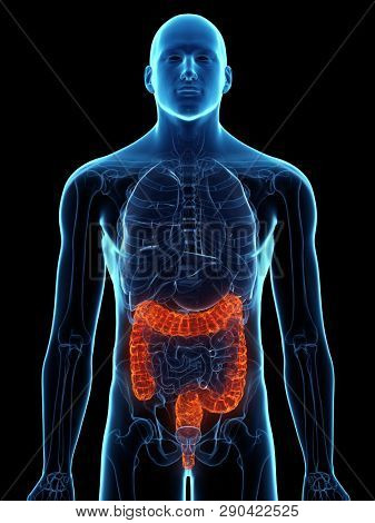 3d rendered medically accurate illustration of a diseased colon