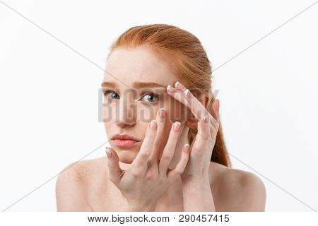 Young Caucsian Woman Squeezes Acne On The Face Of Beauty