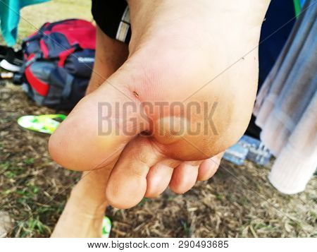 Swollen Under Feet After Walk All Day