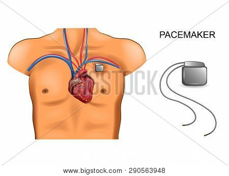 Vector Illustration Of Heart And Pacemaker. Cardiology