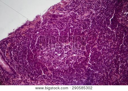 Acute Simple Appendicitis, Light Micrograph, Photo Under Microscope