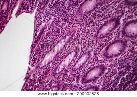 Acute Simple Appendicitis, Light Micrograph, Photo Under Microscope