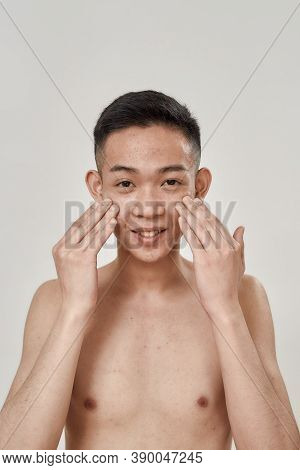 Portrait Of Young Asian Man With Problematic Skin And Hyperpigmentation Smiling At Camera, Applying 
