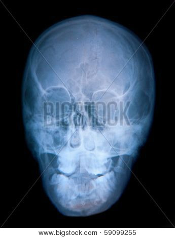 X-ray of a deformed skull