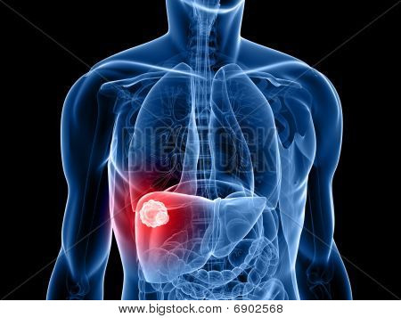tumore del fegato