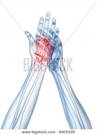 x-ray hands - arthritis