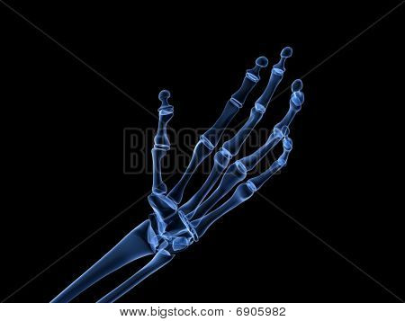 x-ray hand - arthritis