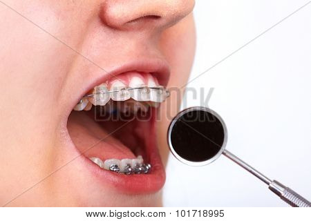 Teeth with orthodontic brackets. Dental health care.