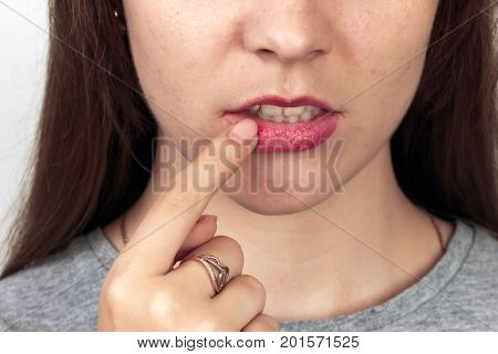 Close up portrait of a pretty woman beautiful lips infected herpes virus. Woman with herpes over gray background virus.