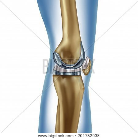 Replacement knee implant medical concept as a human leg anatomy after a prosthetic surgery as a musculoskeletal disease treatment symbol for orthopedics with 3D illustration elements on white.